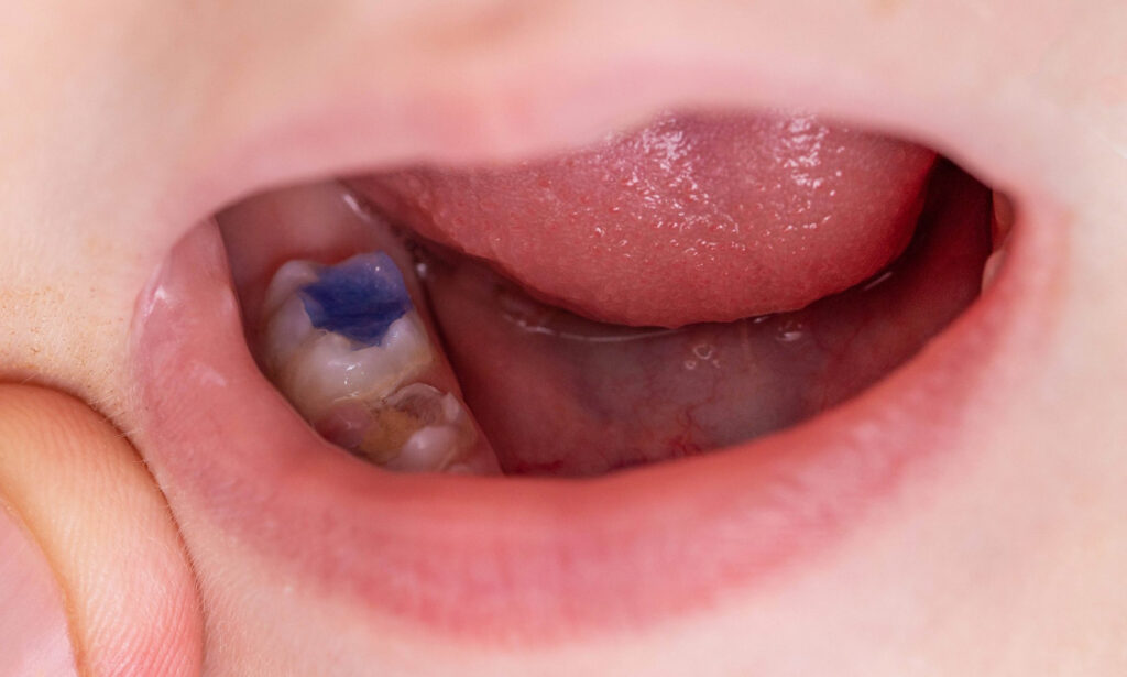 Tooth-Coloured Fillings